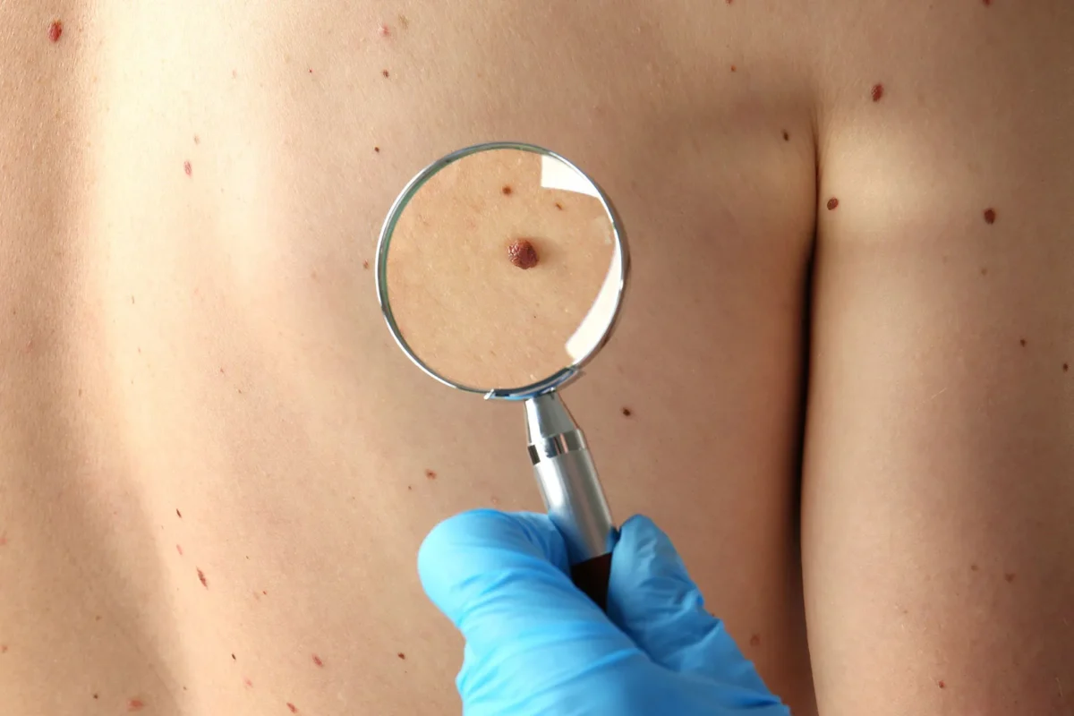 skin11